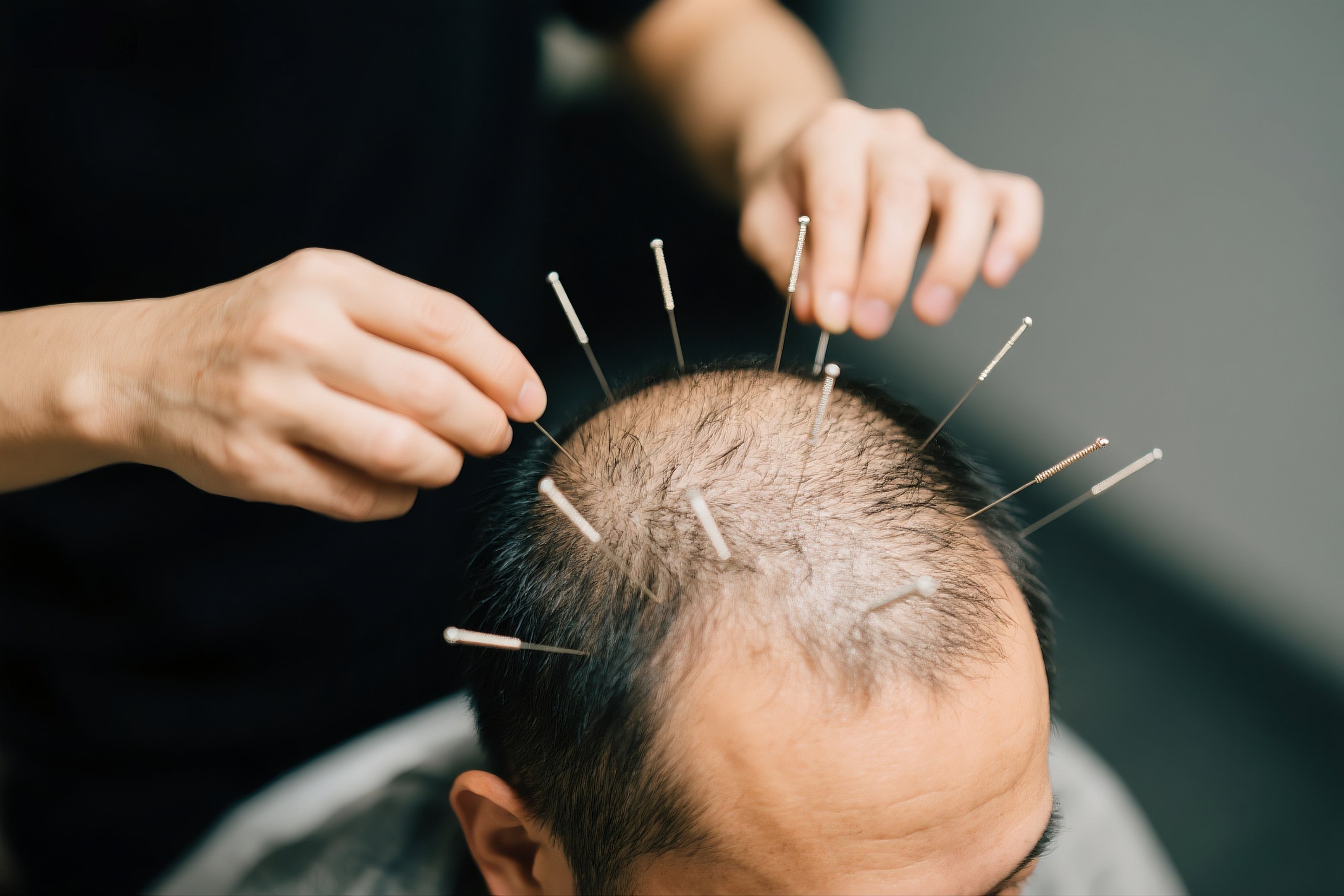 Hair Loss Management
